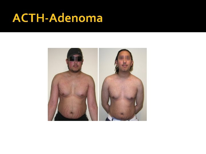 ACTH-Adenoma 