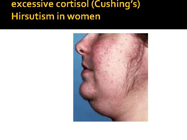 excessive cortisol (Cushing’s) Hirsutism in women 