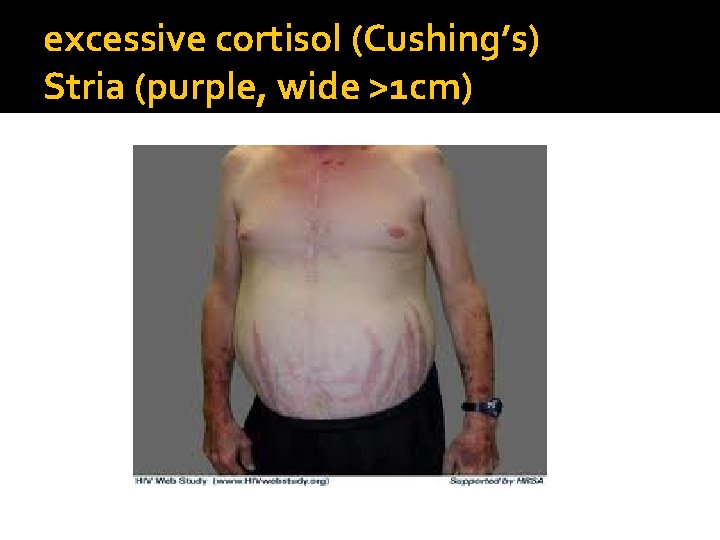 excessive cortisol (Cushing’s) Stria (purple, wide >1 cm) 