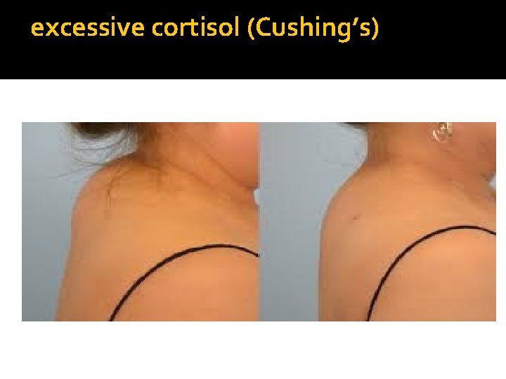 excessive cortisol (Cushing’s) 