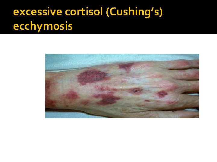 excessive cortisol (Cushing’s) ecchymosis 