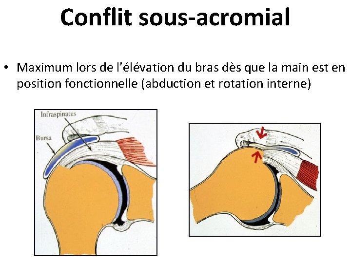 Conflit sous-acromial • Maximum lors de l’élévation du bras dès que la main est