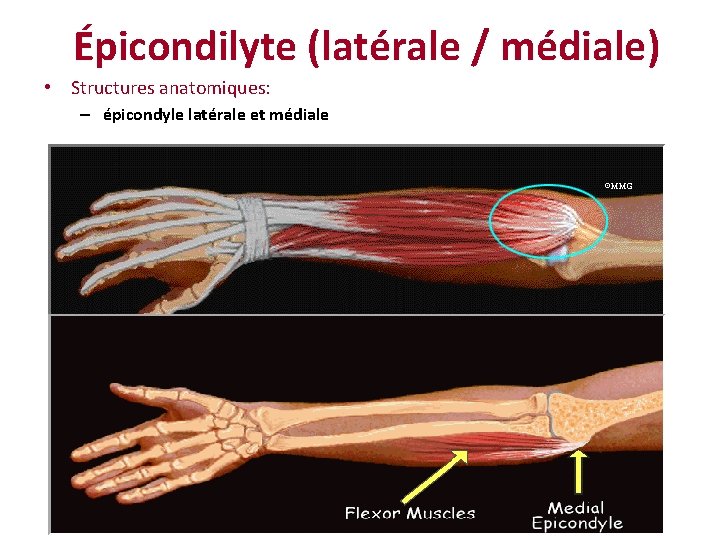 Épicondilyte (latérale / médiale) • Structures anatomiques: – épicondyle latérale et médiale 