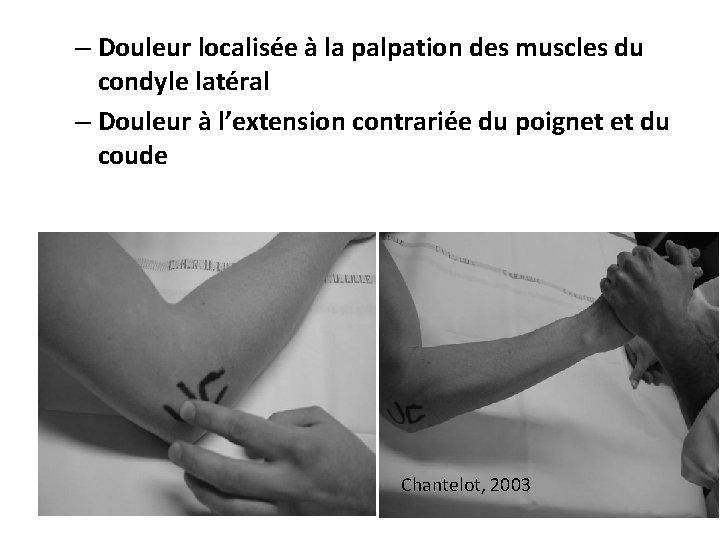 – Douleur localisée à la palpation des muscles du condyle latéral – Douleur à