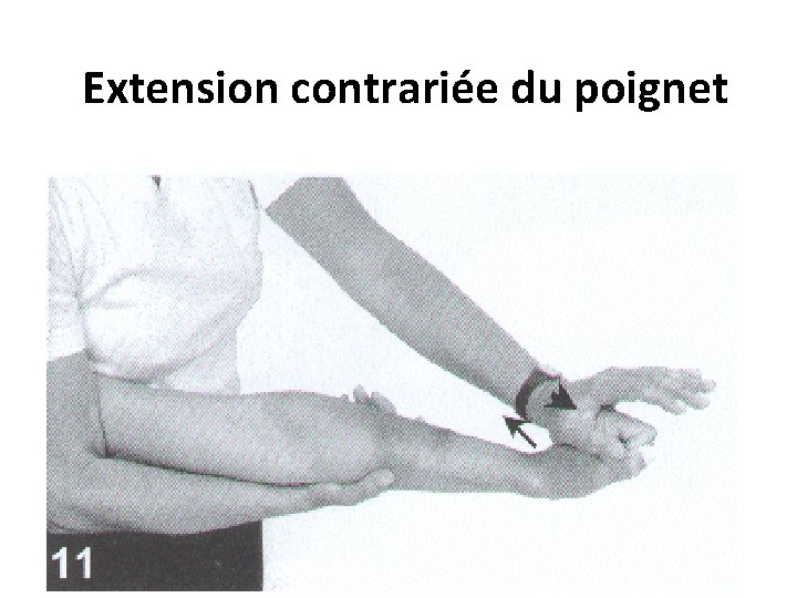  Extension contrariée du poignet 