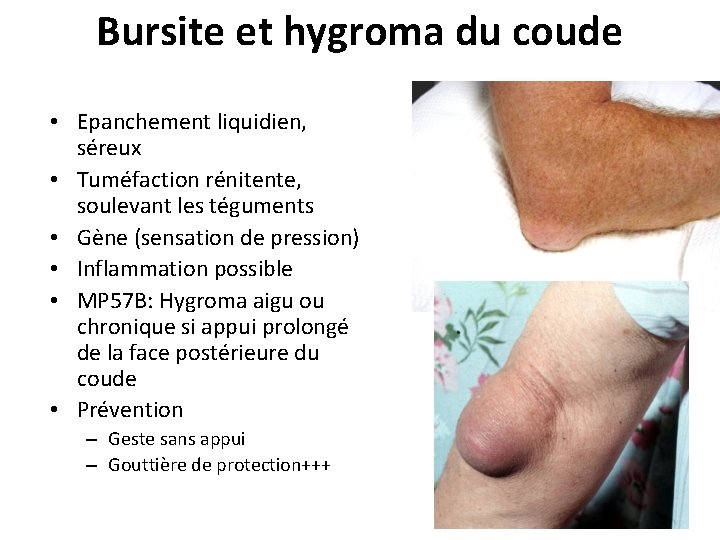 Bursite et hygroma du coude • Epanchement liquidien, séreux • Tuméfaction rénitente, soulevant les