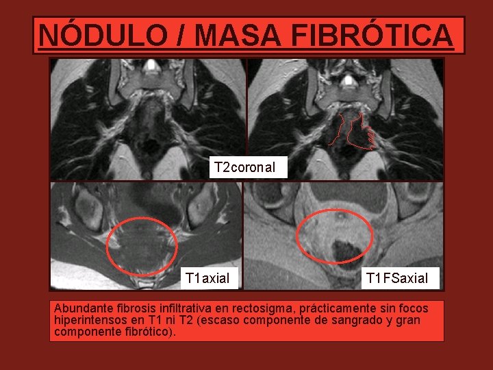NÓDULO / MASA FIBRÓTICA T 2 coronal T 1 axial T 1 FSaxial Abundante