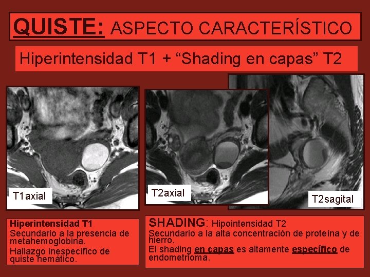 QUISTE: ASPECTO CARACTERÍSTICO Hiperintensidad T 1 + “Shading en capas” T 2 T 1