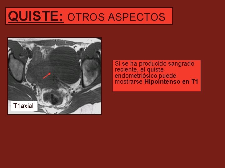 QUISTE: OTROS ASPECTOS Si se ha producido sangrado reciente, el quiste endometriósico puede mostrarse