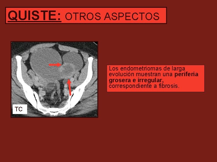 QUISTE: OTROS ASPECTOS Los endometriomas de larga evolución muestran una periferia grosera e irregular,