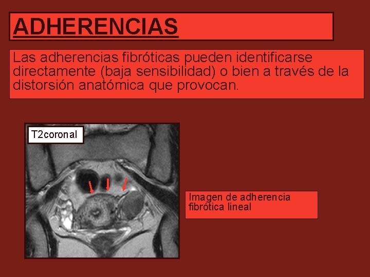 ADHERENCIAS Las adherencias fibróticas pueden identificarse directamente (baja sensibilidad) o bien a través de