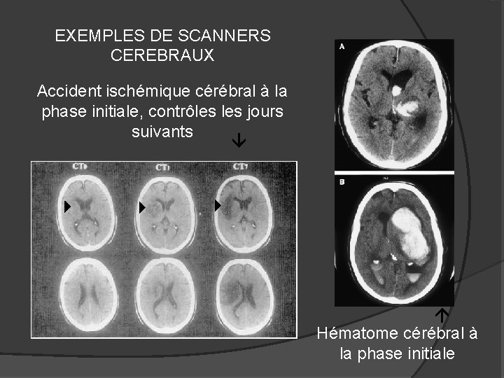 EXEMPLES DE SCANNERS CEREBRAUX Accident ischémique cérébral à la phase initiale, contrôles jours suivants