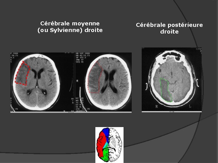 Cérébrale moyenne (ou Sylvienne) droite Cérébrale postérieure droite 