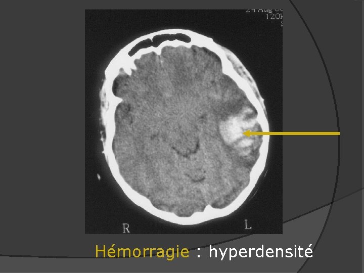 Hémorragie : hyperdensité 