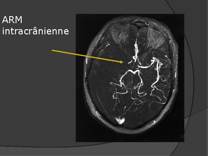 ARM intracrânienne 