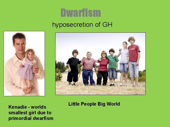 Dwarfism hyposecretion of GH Kenadie - worlds smallest girl due to primordial dwarfism Little