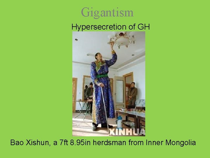 Gigantism Hypersecretion of GH Bao Xishun, a 7 ft 8. 95 in herdsman from