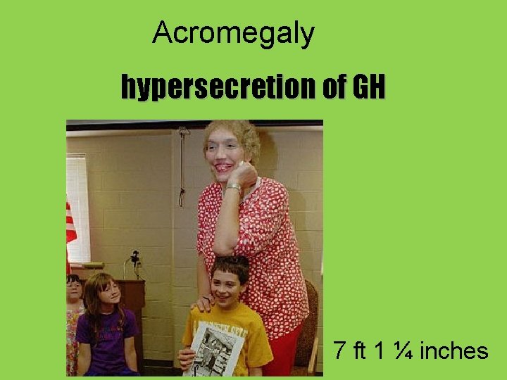Acromegaly hypersecretion of GH 7 ft 1 ¼ inches 