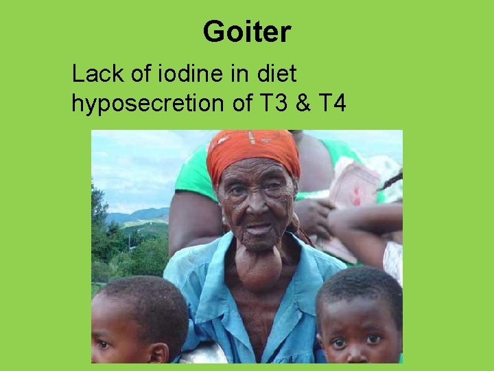 Goiter Lack of iodine in diet hyposecretion of T 3 & T 4 