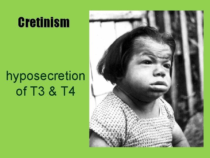 Cretinism hyposecretion of T 3 & T 4 