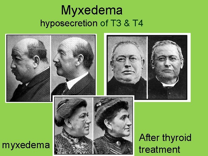 Myxedema hyposecretion of T 3 & T 4 myxedema After thyroid treatment 