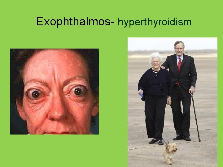 Exophthalmos- hyperthyroidism 