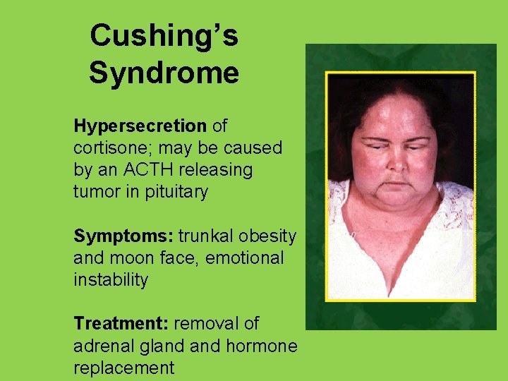 Cushing’s Syndrome Hypersecretion of cortisone; may be caused by an ACTH releasing tumor in