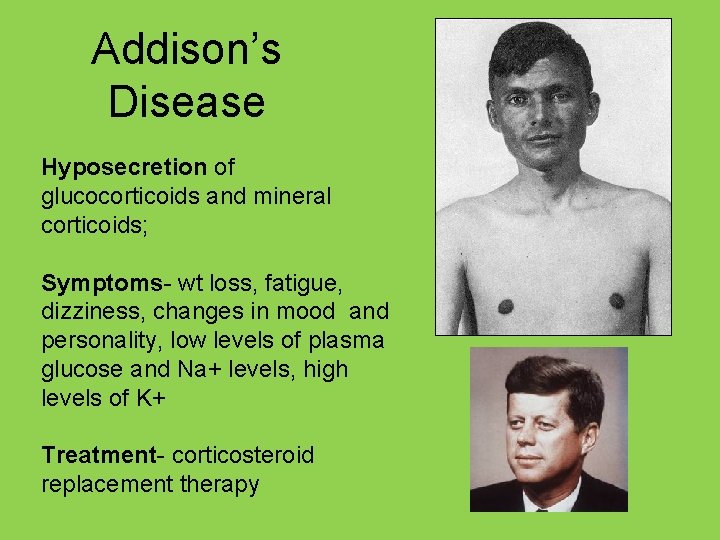 Addison’s Disease Hyposecretion of glucocorticoids and mineral corticoids; Symptoms- wt loss, fatigue, dizziness, changes