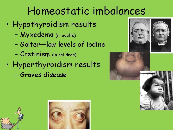 Homeostatic imbalances • Hypothyroidism results – Myxedema (in adults) – Goiter—low levels of iodine