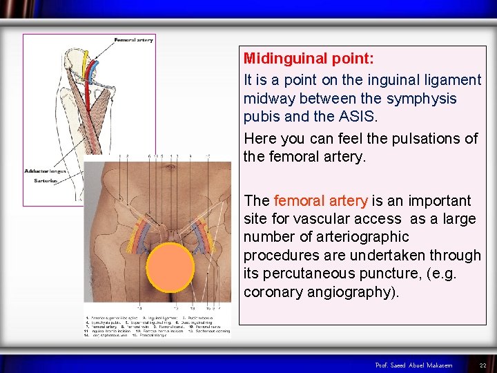 Midinguinal point: It is a point on the inguinal ligament midway between the symphysis