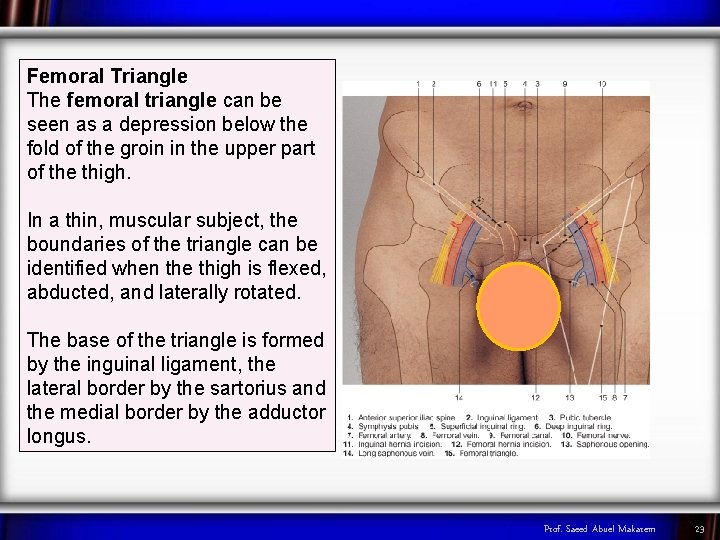 Femoral Triangle The femoral triangle can be seen as a depression below the fold