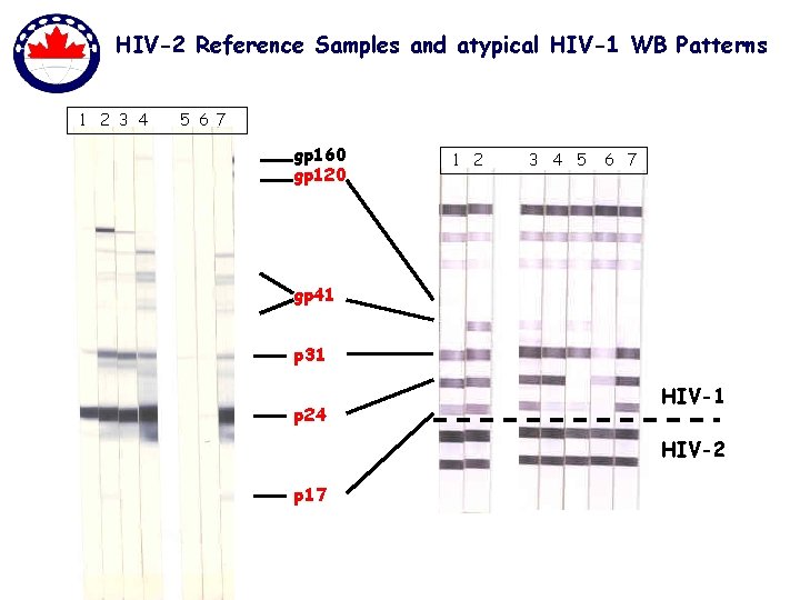 HIV-2 Reference Samples and atypical HIV-1 WB Patterns 1 2 3 4 5 6