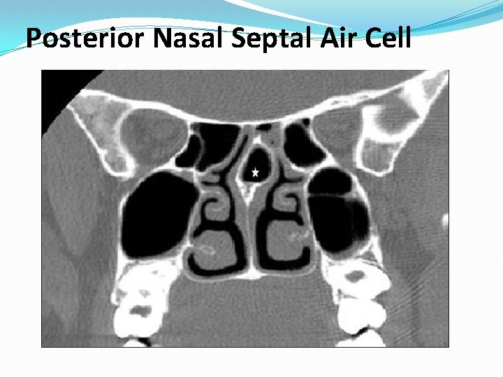 Posterior Nasal Septal Air Cell Posterior Nasal Septal Air Cell