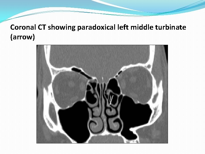 Coronal CT showing paradoxical left middle turbinate (arrow) Coronal CT showing paradoxical left middle turbinate (arrow)