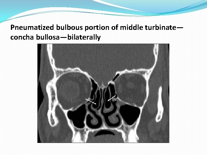 Pneumatized bulbous portion of middle turbinate— concha bullosa—bilaterally Pneumatized bulbous portion of middle turbinate— concha bullosa—bilaterally