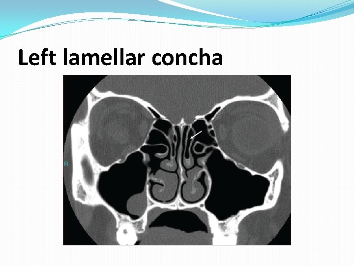 Left lamellar concha Left lamellar concha