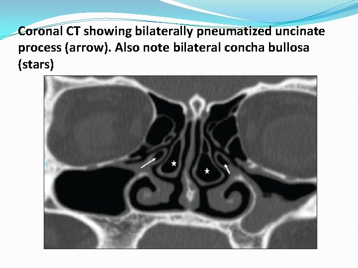 Coronal CT showing bilaterally pneumatized uncinate process (arrow). Also note bilateral concha bullosa (stars) Coronal CT showing bilaterally pneumatized uncinate process (arrow). Also note bilateral concha bullosa (stars)