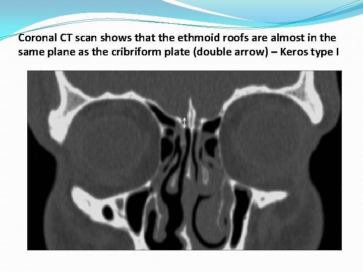 Coronal CT scan shows that the ethmoid roofs are almost in the same plane Coronal CT scan shows that the ethmoid roofs are almost in the same plane
