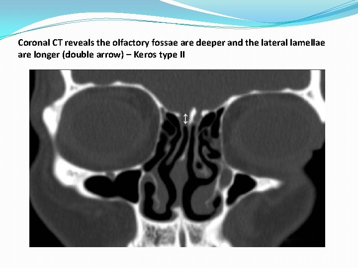 Coronal CT reveals the olfactory fossae are deeper and the lateral lamellae are longer Coronal CT reveals the olfactory fossae are deeper and the lateral lamellae are longer