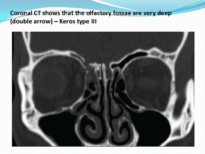 Coronal CT shows that the olfactory fossae are very deep (double arrow) – Keros Coronal CT shows that the olfactory fossae are very deep (double arrow) – Keros
