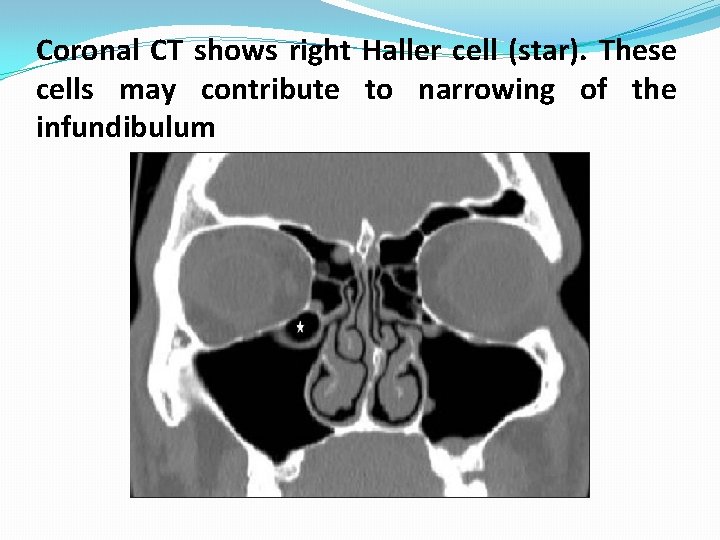 Coronal CT shows right Haller cell (star). These cells may contribute to narrowing of Coronal CT shows right Haller cell (star). These cells may contribute to narrowing of
