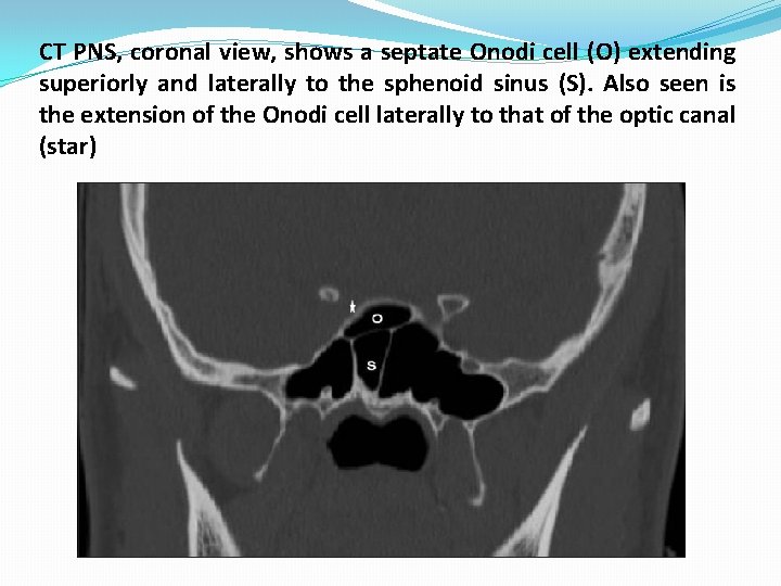CT PNS, coronal view, shows a septate Onodi cell (O) extending superiorly and laterally CT PNS, coronal view, shows a septate Onodi cell (O) extending superiorly and laterally