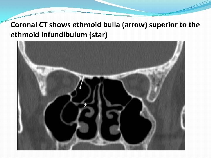 Coronal CT shows ethmoid bulla (arrow) superior to the ethmoid infundibulum (star) Coronal CT shows ethmoid bulla (arrow) superior to the ethmoid infundibulum (star)