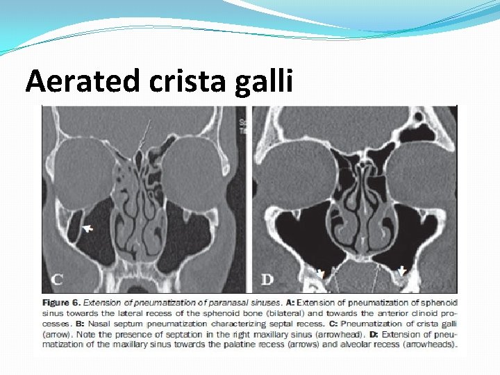 Aerated crista galli Aerated crista galli
