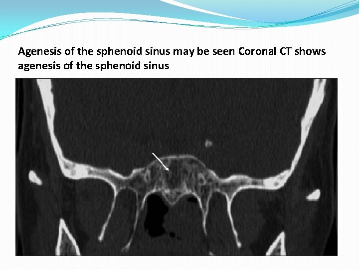 Agenesis of the sphenoid sinus may be seen Coronal CT shows agenesis of the Agenesis of the sphenoid sinus may be seen Coronal CT shows agenesis of the