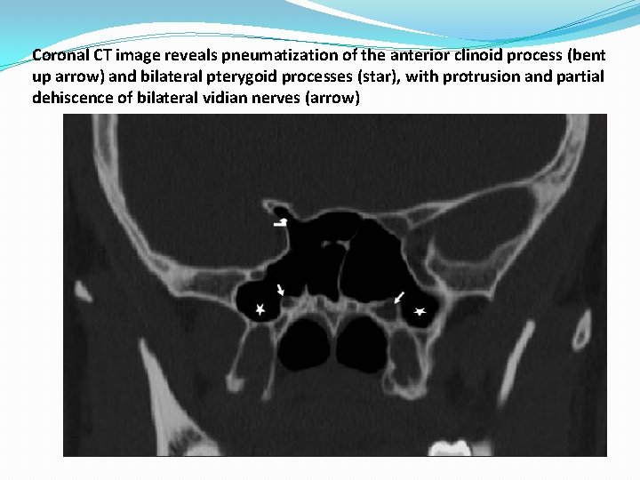 Coronal CT image reveals pneumatization of the anterior clinoid process (bent up arrow) and Coronal CT image reveals pneumatization of the anterior clinoid process (bent up arrow) and