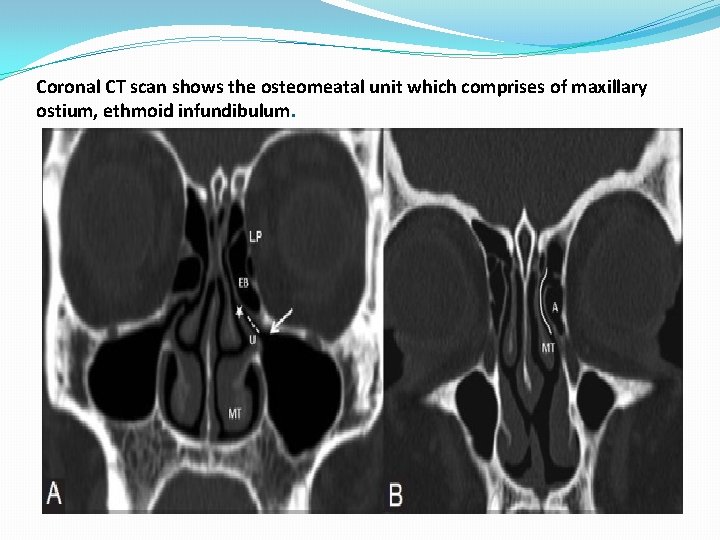 Coronal CT scan shows the osteomeatal unit which comprises of maxillary ostium, ethmoid infundibulum. Coronal CT scan shows the osteomeatal unit which comprises of maxillary ostium, ethmoid infundibulum.
