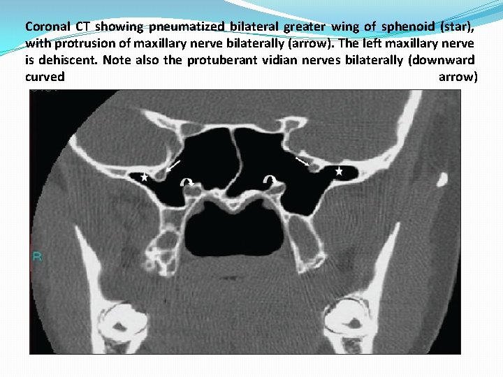 Coronal CT showing pneumatized bilateral greater wing of sphenoid (star), with protrusion of maxillary Coronal CT showing pneumatized bilateral greater wing of sphenoid (star), with protrusion of maxillary
