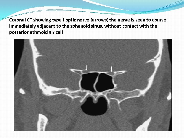 Coronal CT showing type I optic nerve (arrows) the nerve is seen to course Coronal CT showing type I optic nerve (arrows) the nerve is seen to course