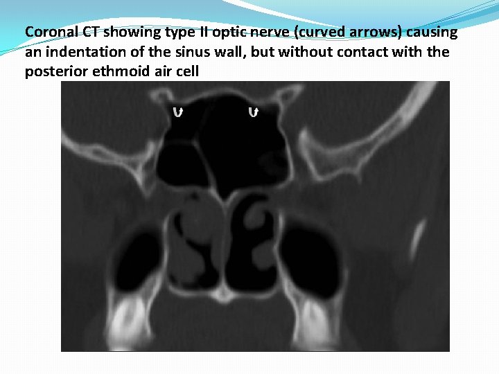 Coronal CT showing type II optic nerve (curved arrows) causing an indentation of the Coronal CT showing type II optic nerve (curved arrows) causing an indentation of the